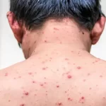 تعبیر خواب آبله مرغان گرفتن برای زن متاهل و باردار و دختر مجرد از روانشناسی