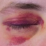 تعبیر خواب کبودی صورت خودم برای زن متاهل و باردار و دختر مجرد از روانشناسی