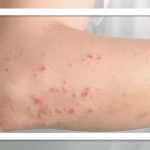 نقش التهاب پوست در شروع آلرژی غذایی