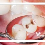 اولین نشانه پوسیدگی دندان چیست؟
