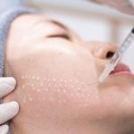 در هر جلسه مزوتراپی چند سی سی تزریق میشود؟