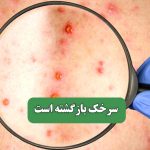 سرخک بازگشته است – سلامت نیوز