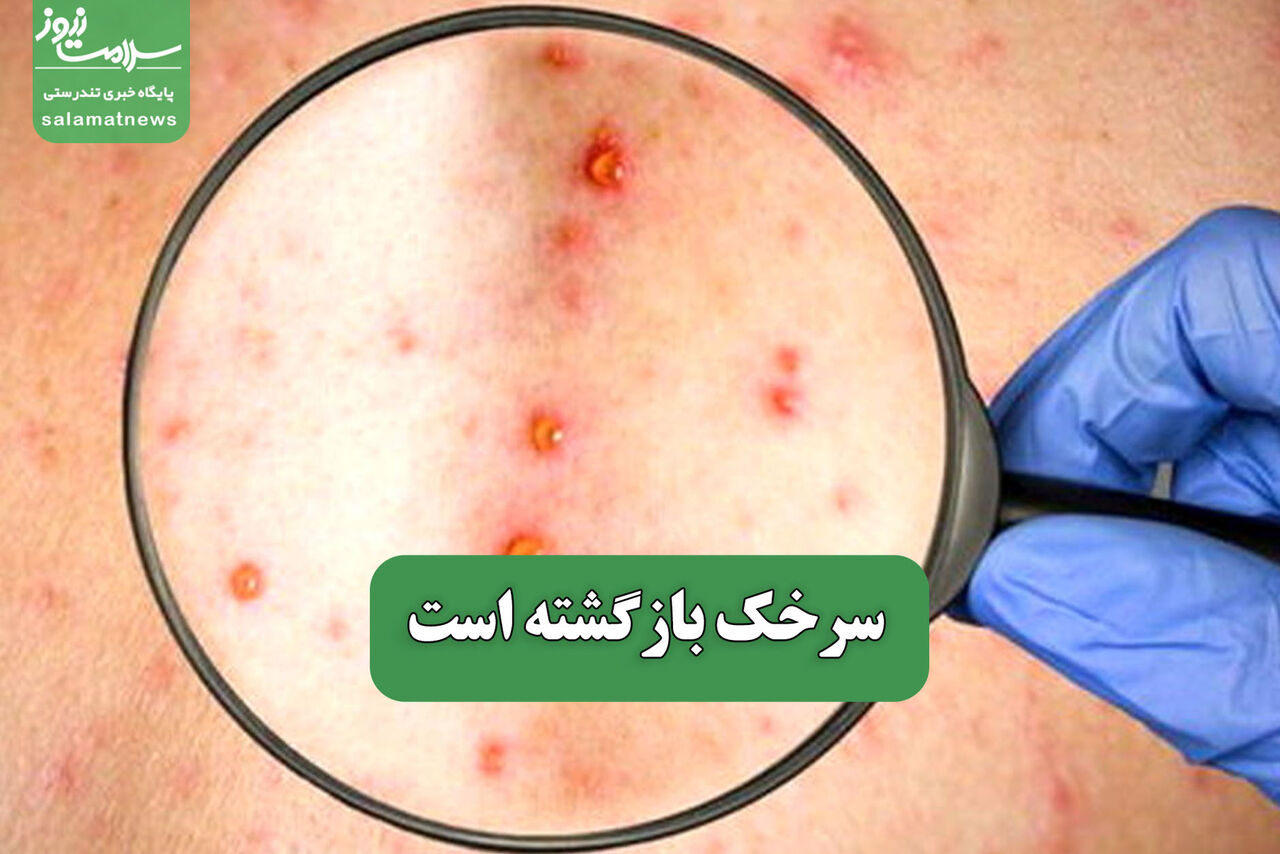 سرخک بازگشته است – سلامت نیوز