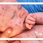 جولان دوباره سرخک – سلامت نیوز