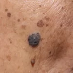 تعبیر خواب خال قهوه ای در بدن برای زن متاهل و باردار و دختر مجرد از روانشناسی