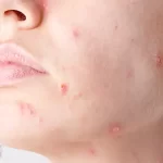 تعبیر خواب بیماری سرطان پوست برای زن متاهل و باردار و دختر مجرد از روانشناسی