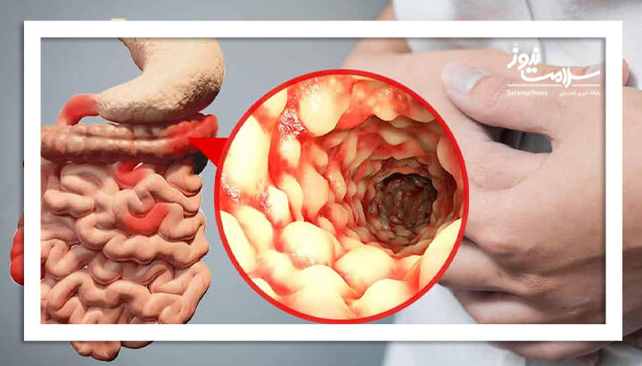 آزمایش خون می تواند بیماری کرون را تشخیص دهد؟