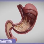 عوارض اسلیو معده؛ آنچه باید قبل از جراحی بدانید