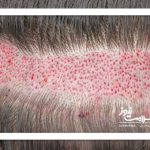 چرا نتیجه کاشت برای همه مو راضی کننده نیست