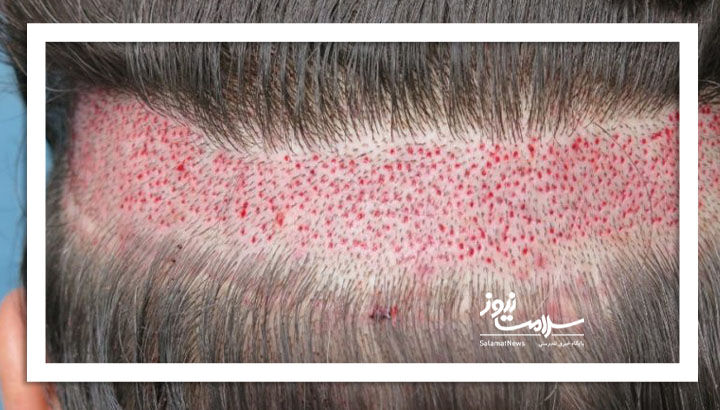 چرا نتیجه کاشت برای همه مو راضی کننده نیست