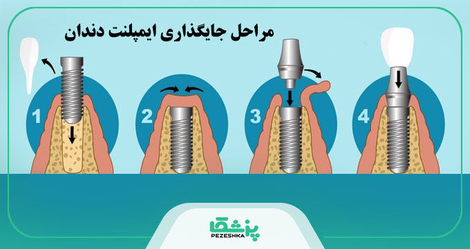 قیمت ایمپلنت دندان در سال 1404 + جدول هزینه انواع برندها【سال1404】