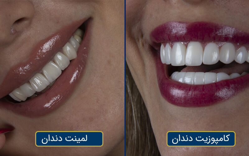 کامپوزیت یا لمینت دندان؟ بررسی تفاوت‌ها، مزایا و انتخاب هوشمندانه