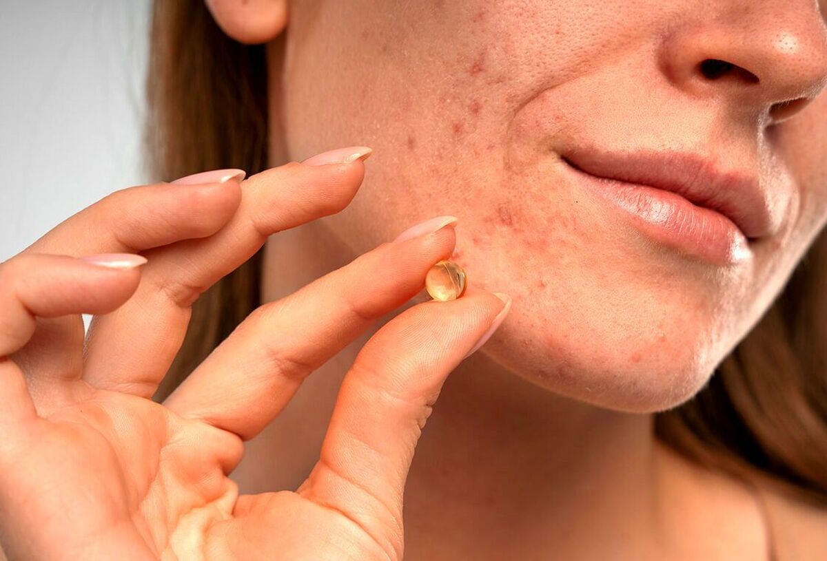 جوش صورت با مصرف قرص استامینوفن بر طرف میشود؛ درمان موثر یا اشتباه رایج؟