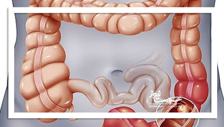 نشانه‌های سرطان روده بزرگ – سلامت نیوز