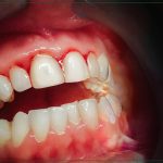 تحلیل لثه در ارتودنسی؛ راهنمای جامع دلایل و راهکارها