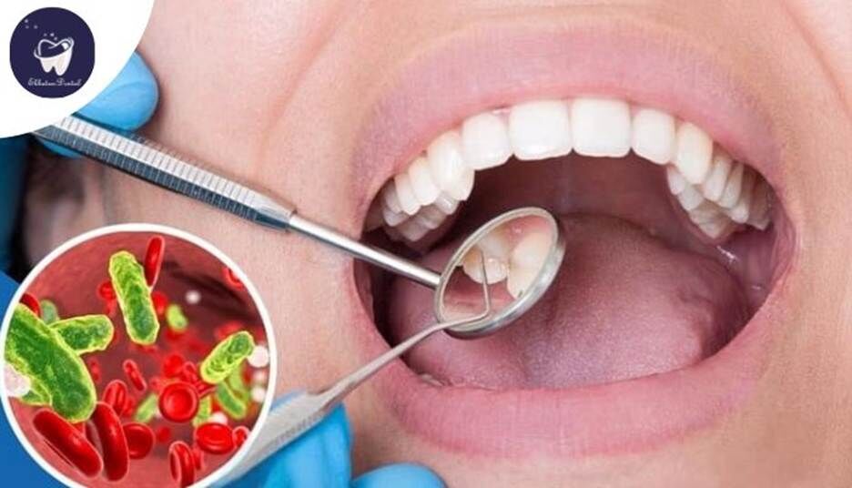 آیا ممکن است عفونت ریشه دندان پس از عصبکشی برگردد؟