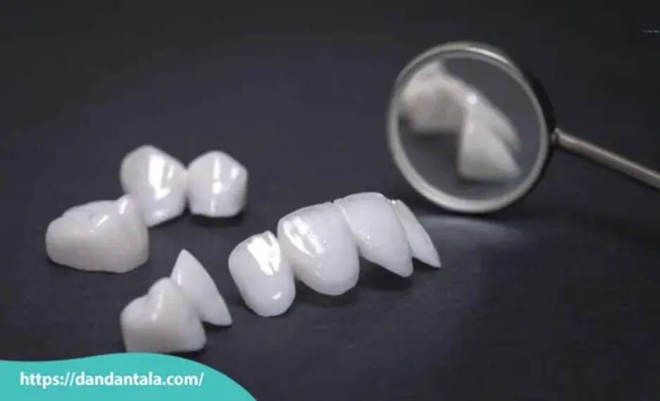 فرق لمینت و کامپوزیت کدام بهتر است؟