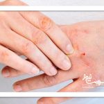 روش‌های غیردارویی برای کنترل التهاب