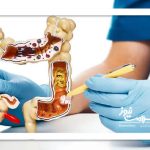 عوامل اصلی رشد سرطان‌های گوارشی در ایران،مصرف الکل و دخانیات متهم شماره یک