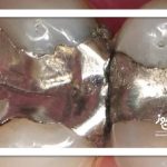 آیا آمالگام سمی است؟ – سلامت نیوز