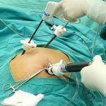 هیستروسکوپی و لاپاراسکوپی زنان؛ درمان ناباروری و موفقیت IVF