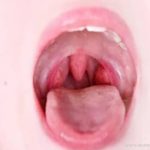 لوزه سوم آیا میتواند باعث مشکلات فکی شود؟