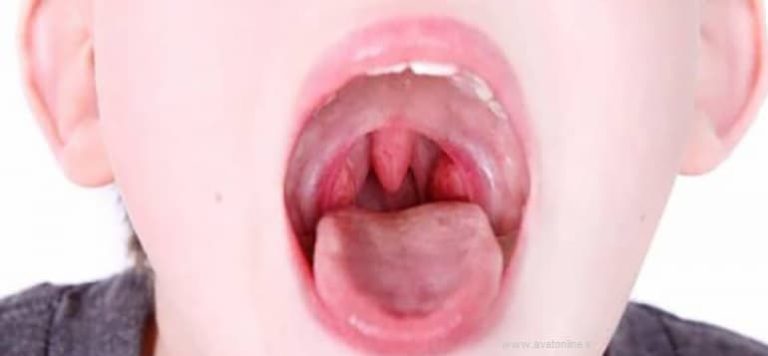 لوزه سوم آیا میتواند باعث مشکلات فکی شود؟