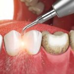 جرمگیری دندان تنها یک «درمان» نیست؛ بخشی از سبک زندگی افراد موفق است!